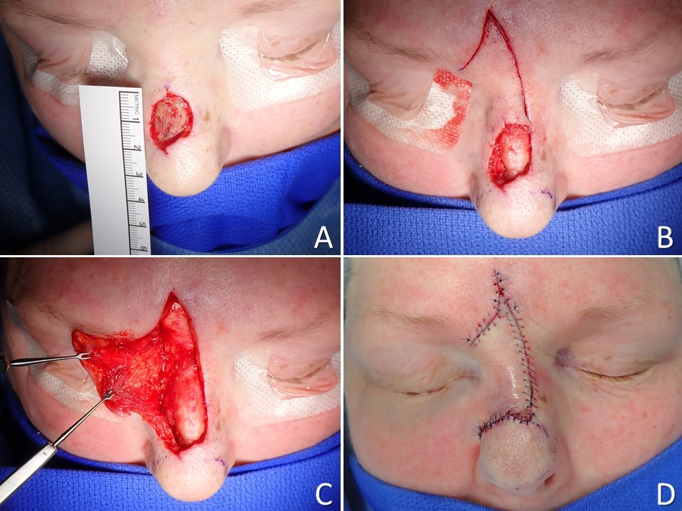 <p>Rieger Dorsal Nasal Rotation-Advancement Flap