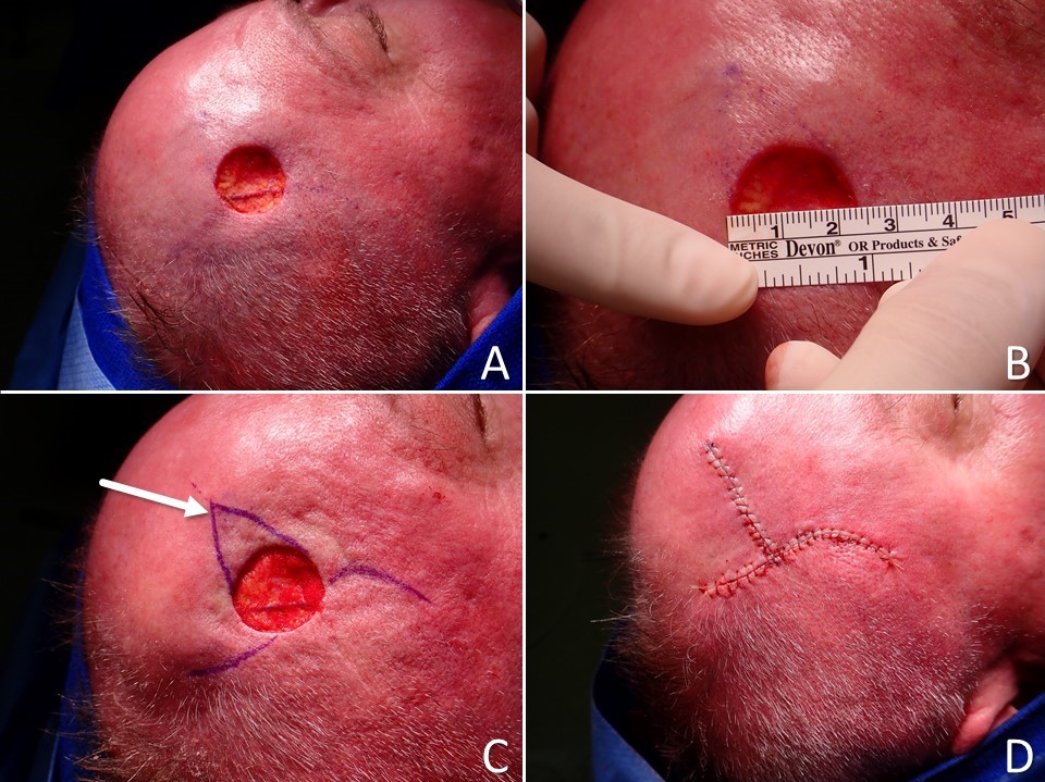 <p>O to T Double Rotation Flap