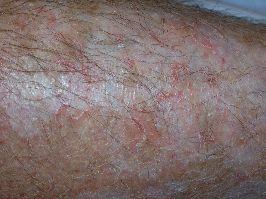 <p>Eczema, Craquele</p>