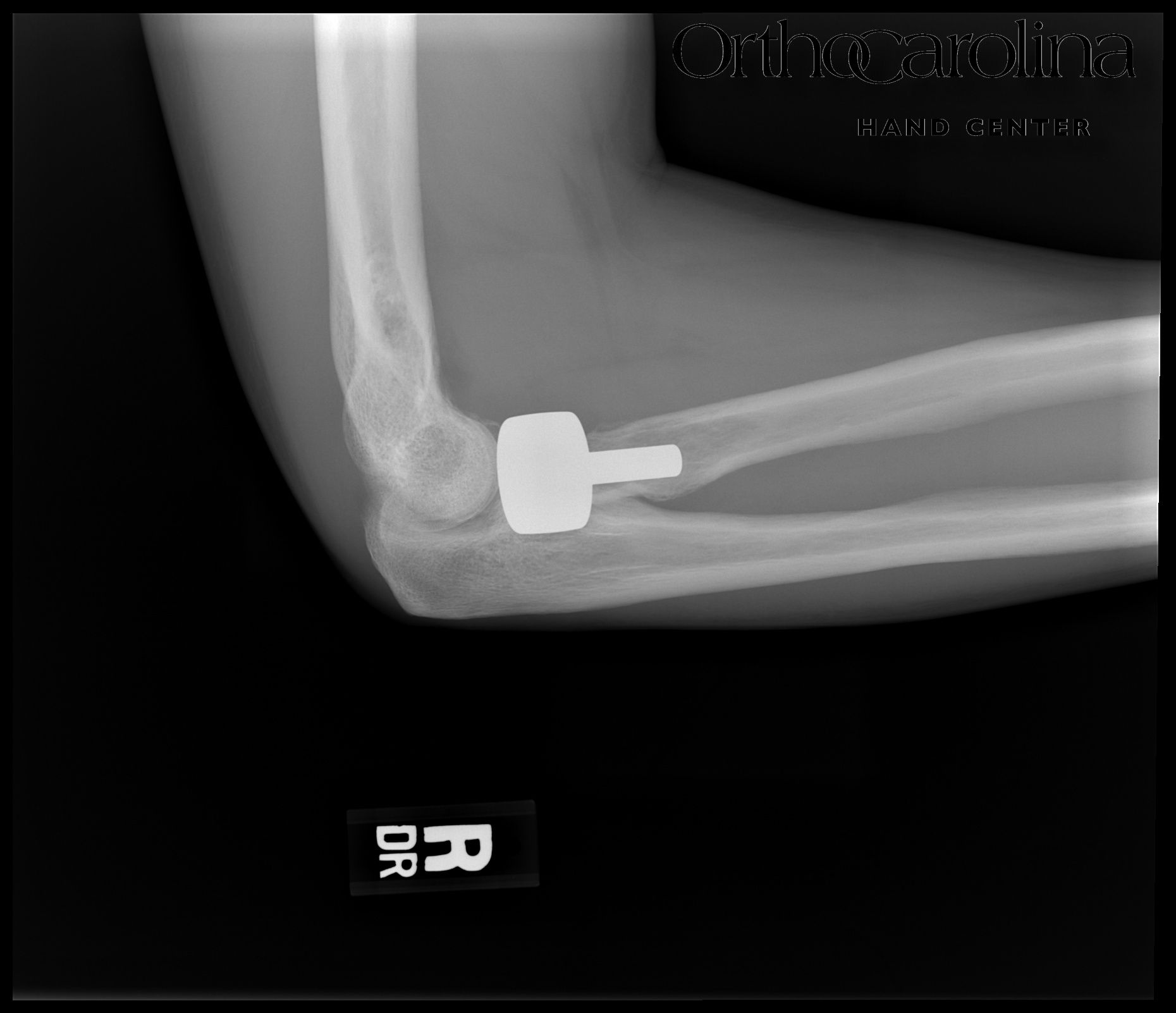 Figure 1. Postoperative radial head arthroplasty with radial head implant