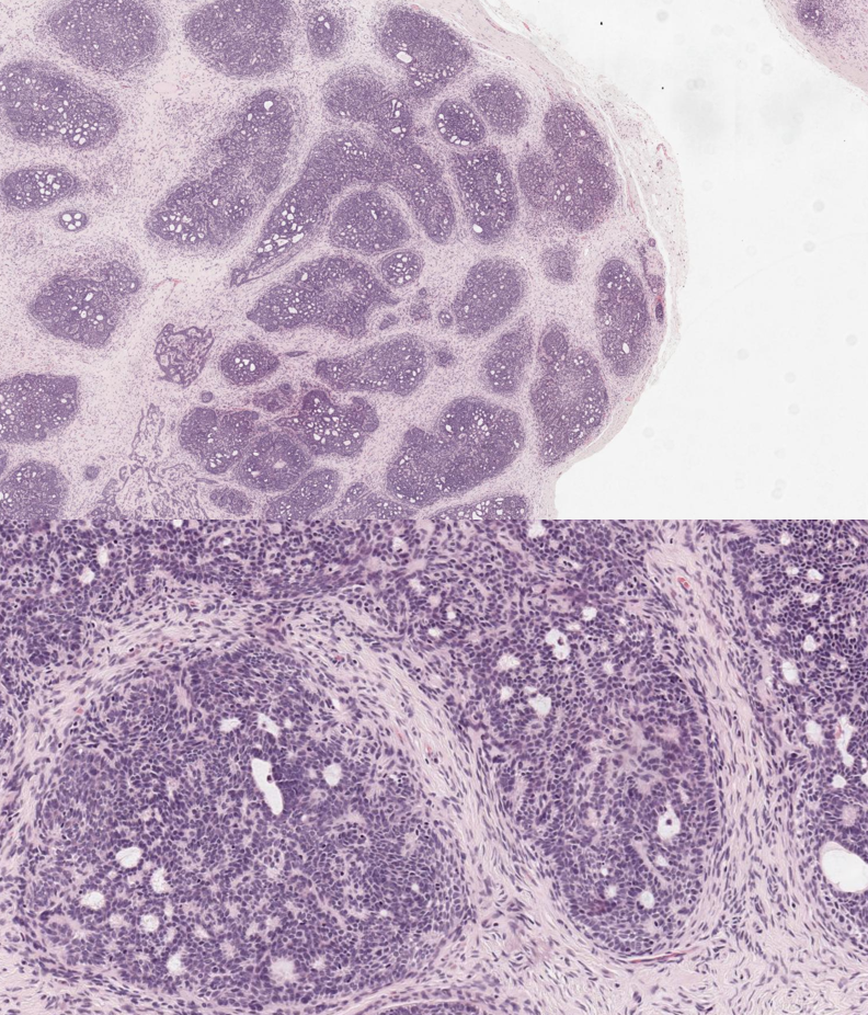 Trichoblastoma