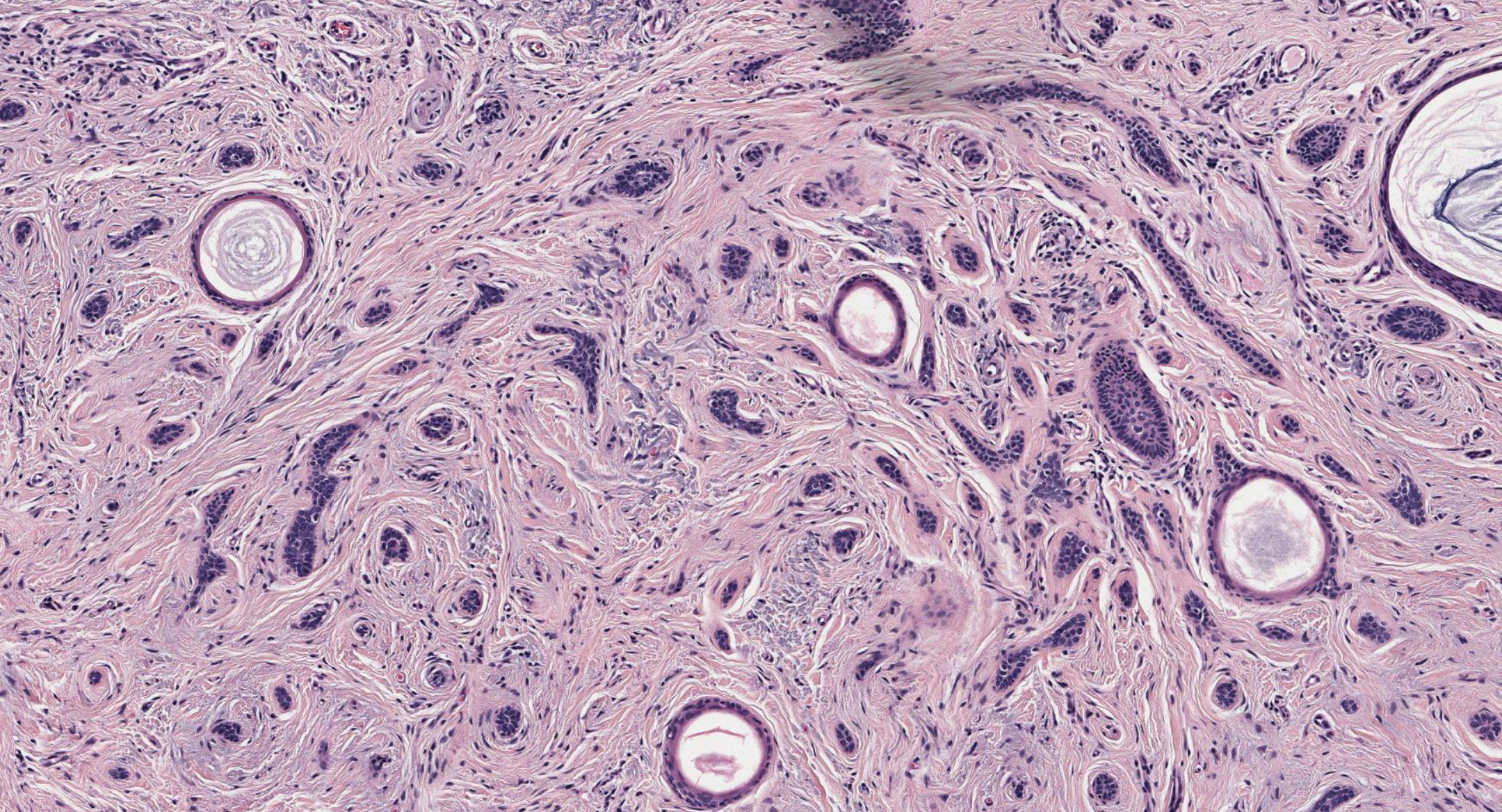 Desmoplastic trichoepithelioma