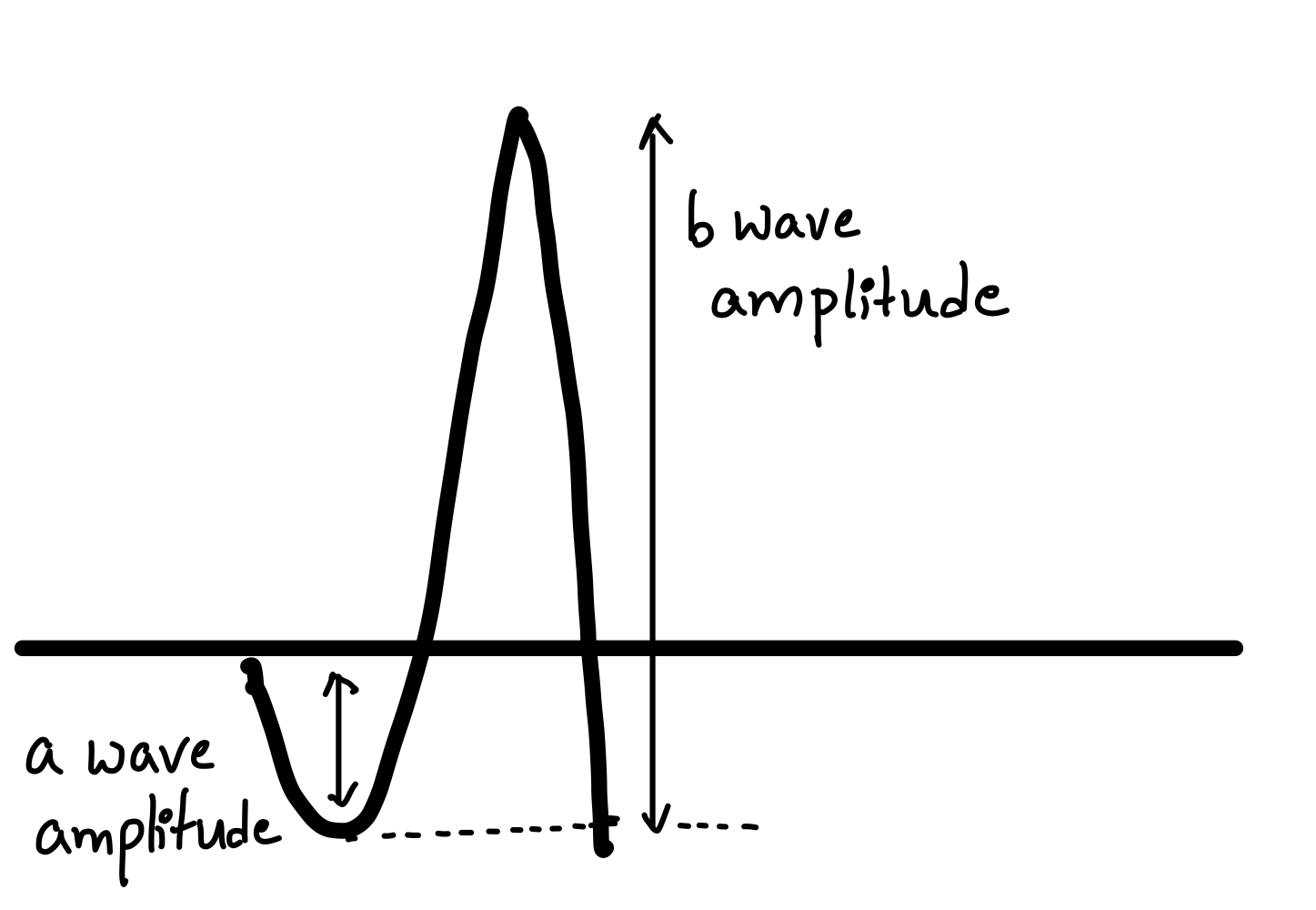 Amplitude of ERG waves