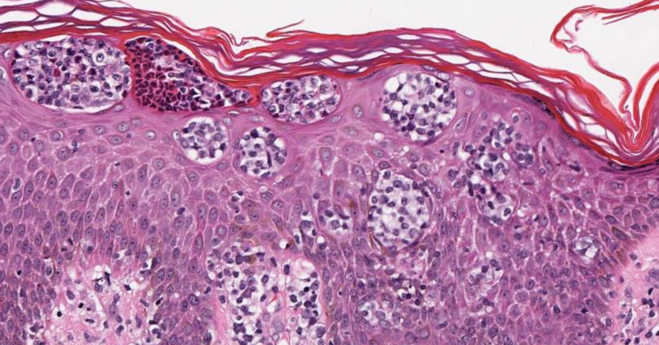 <p>Pautrier Microabscesses</p>