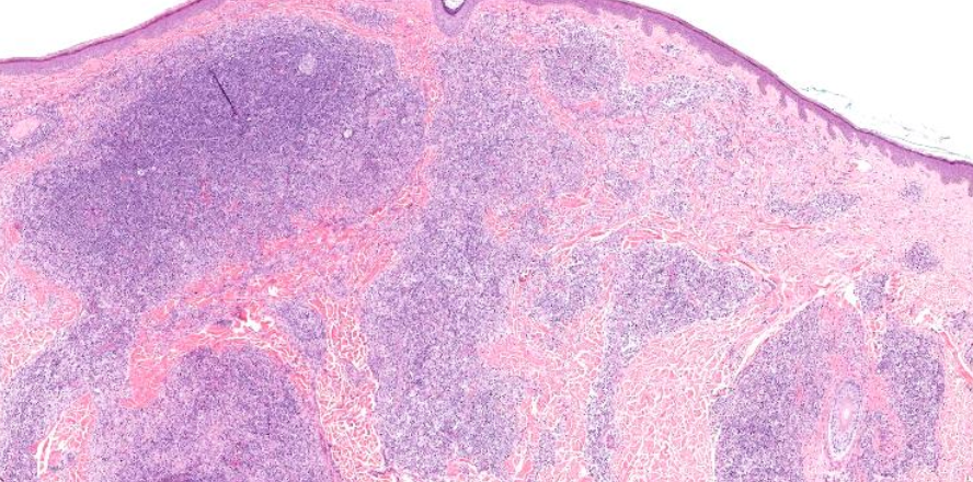 <p>Dense B-Cell Dermal Infiltrate (CBCL)</p>