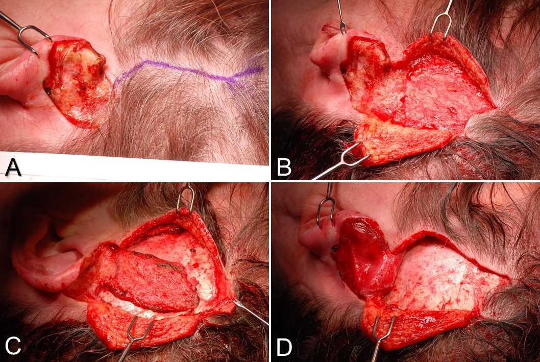 <p>Temporoparietal Fascia Flap