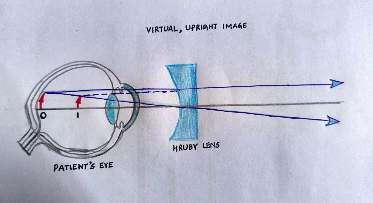 Optical principle of Hruby Lens