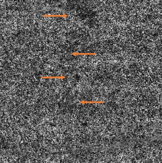 Mild pentosan polysulfate maculopathy without imaging findings on color fundus photography, fundus autofluorescence, or optical coherence tomography is seen here on OCT-Angiography as increased flow deficits (examples highlighted in orange), lending a moth-eaten appearance