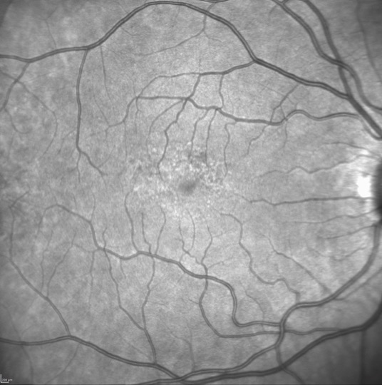 Mild pentosan polysulfate maculopathy as imaged on near infrared reflectance