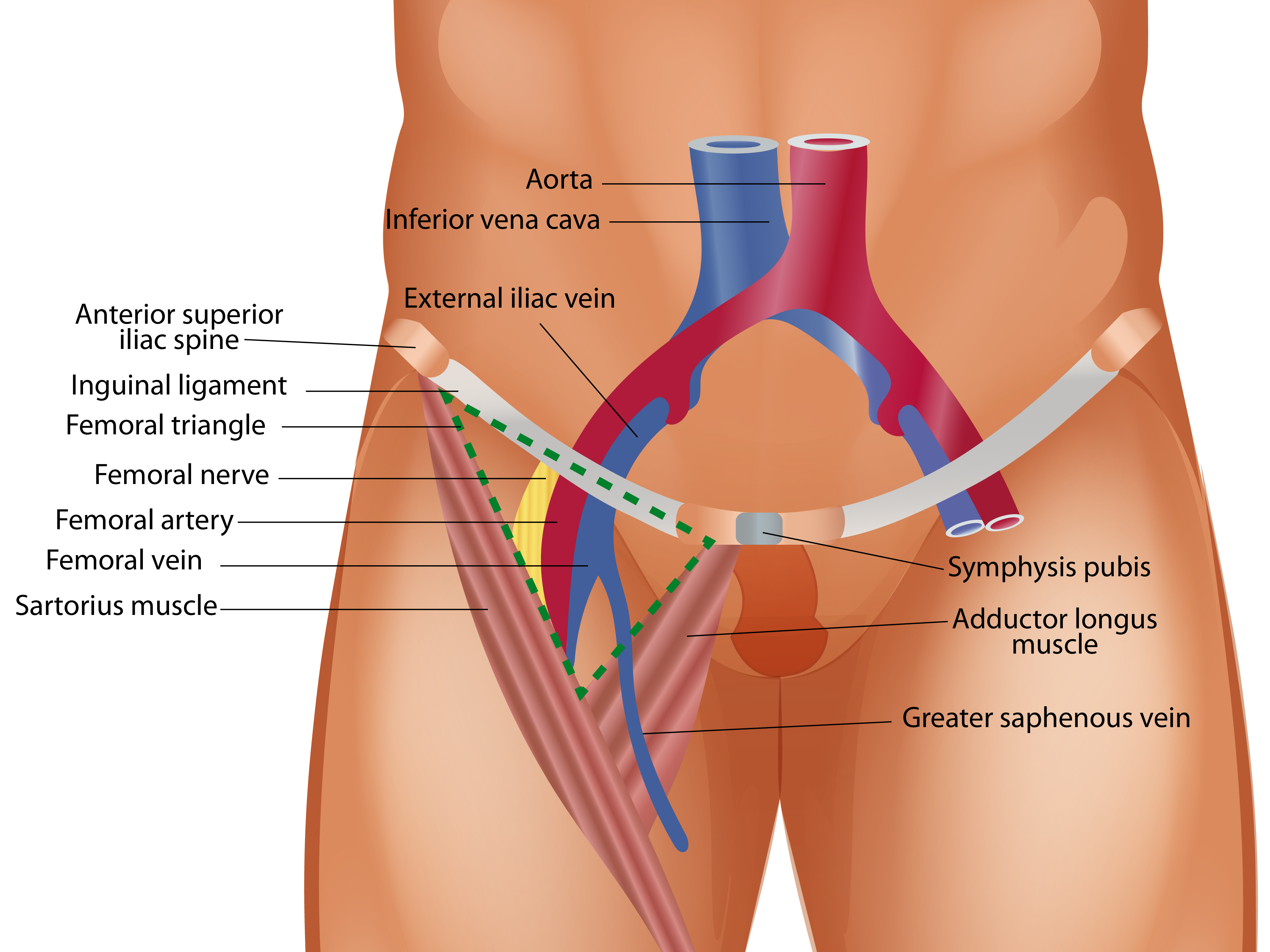 This figure illustrates femoral triangle, bounded superiorly by inguinal ligament, laterally by medial border of sartorius muscle and medially by lateral border of adductor longus muscle