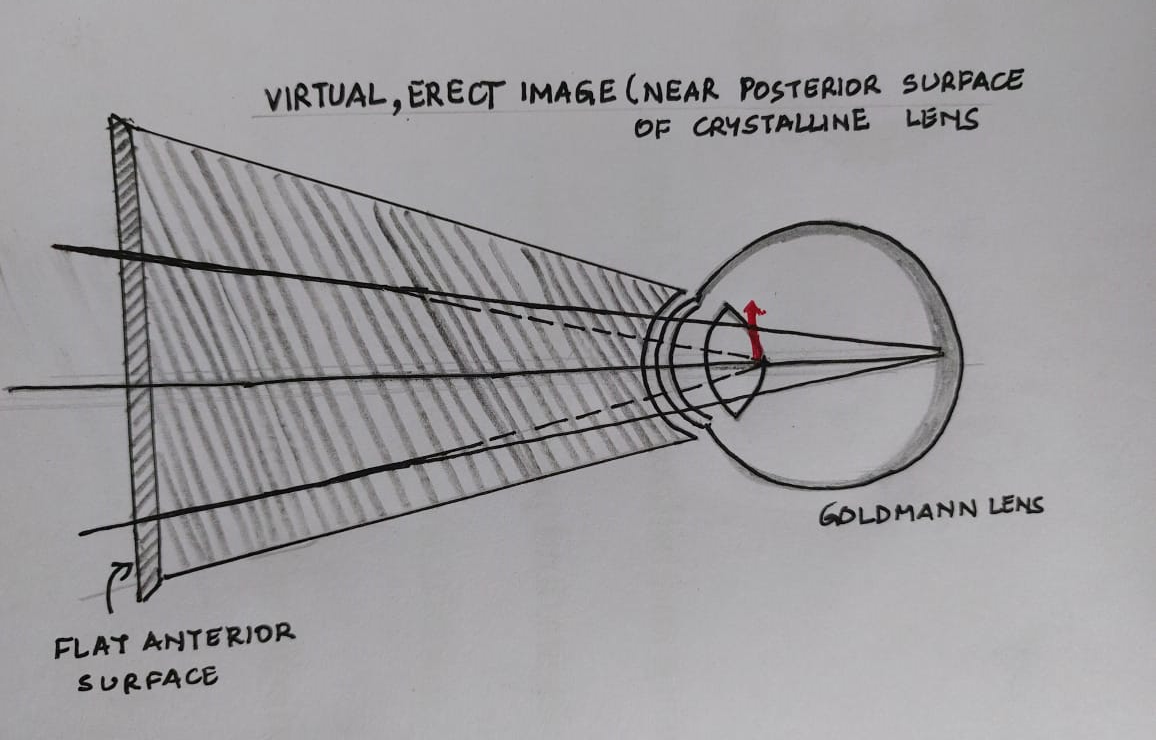 Optics of the central lens of the Goldmann contact lens [virtual erect image]