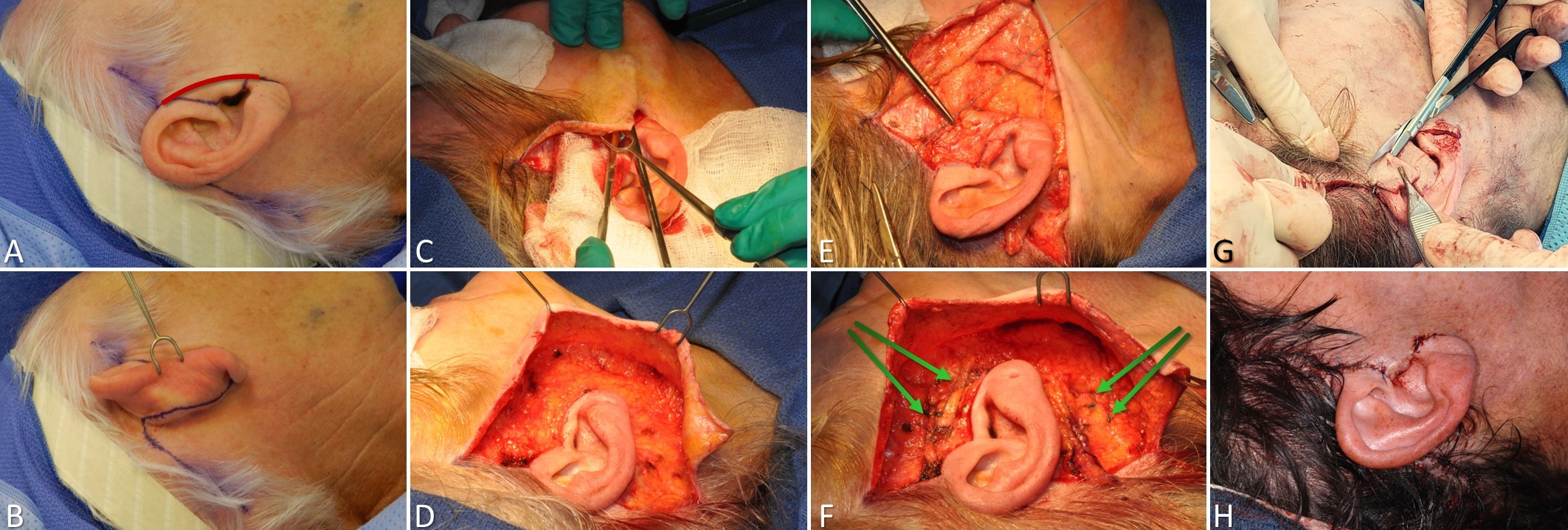 <p>SMAS Plication Rhytidectomy