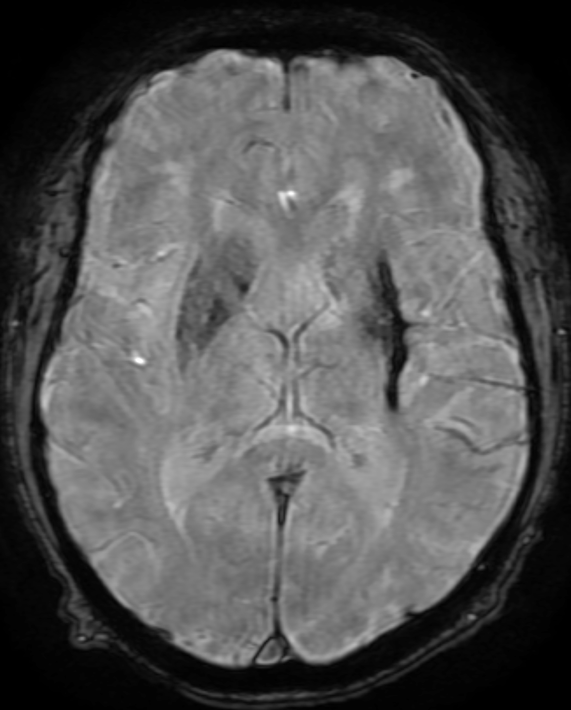 <p>Chronic Hypertensive Hemorrhage