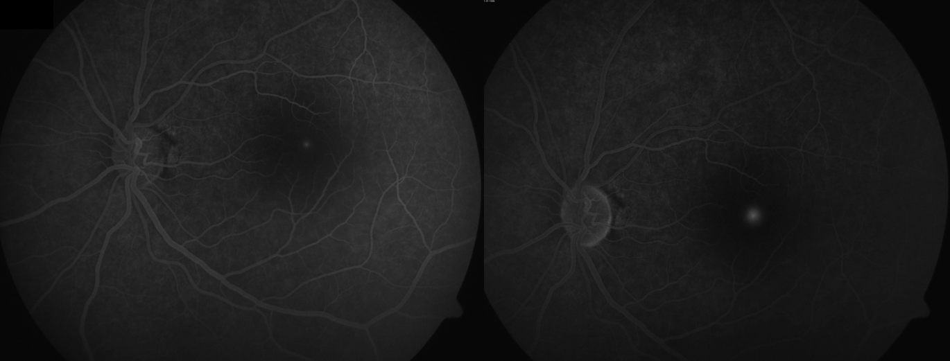 Ink blot leak in central serous chorioretinopathy (CSCR or CSR)