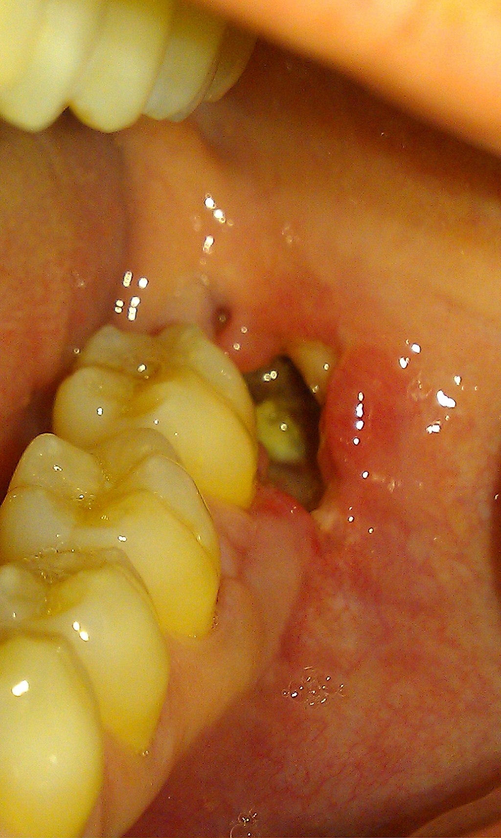 <p>Alveolar osteitis with alveolar bone exposure after exodontia</p>