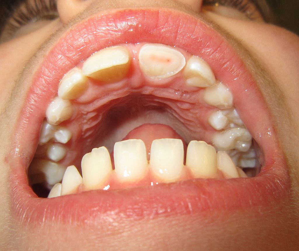 <p>Tooth fracture demonstrating with dentin and pulp involvement</p>
