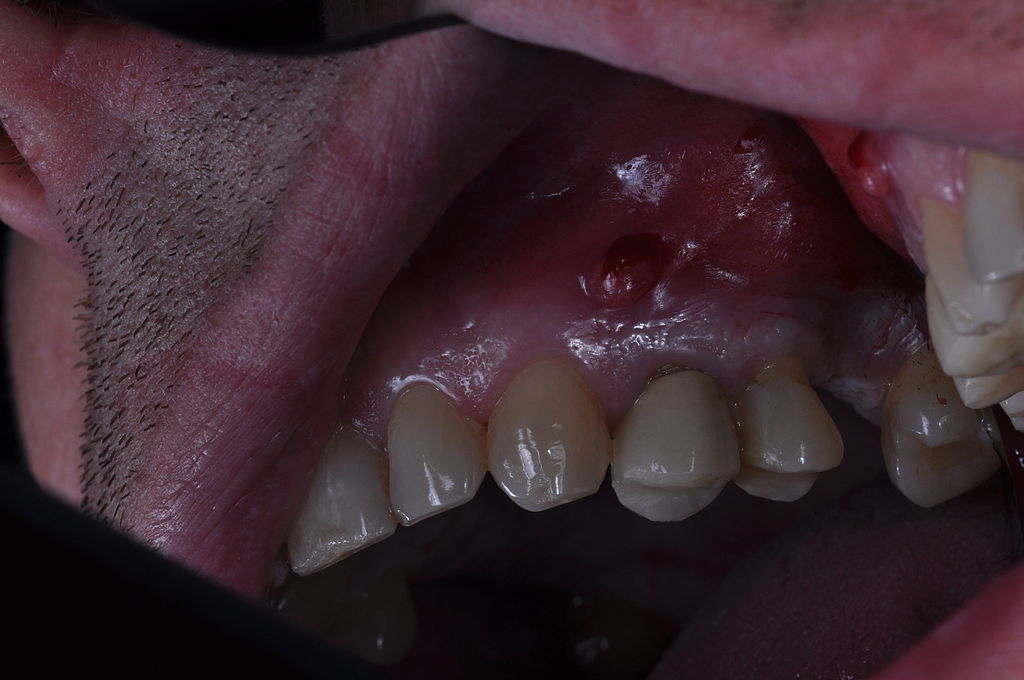 <p>Periapical abscess</p>