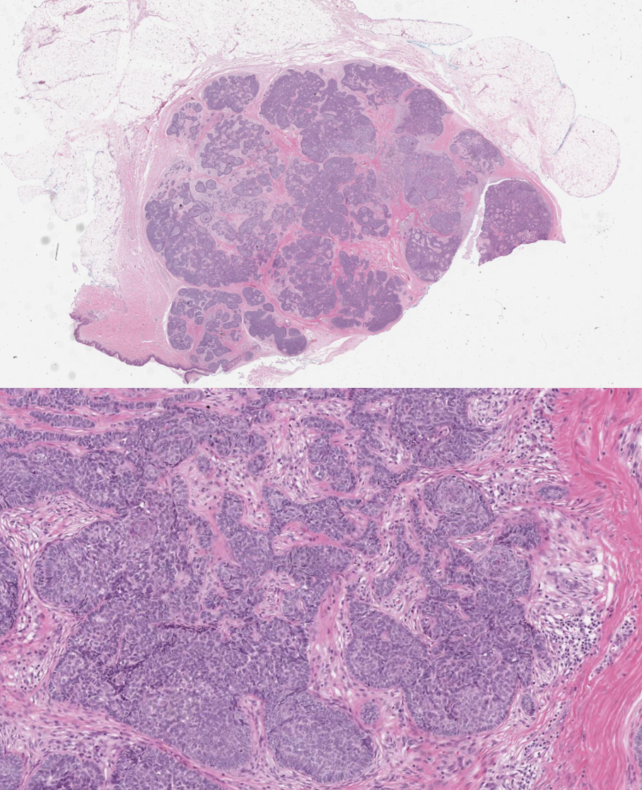 Trichoblastoma path