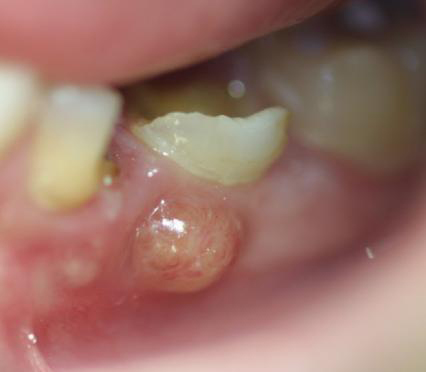 <p>Dental Abscess</p>