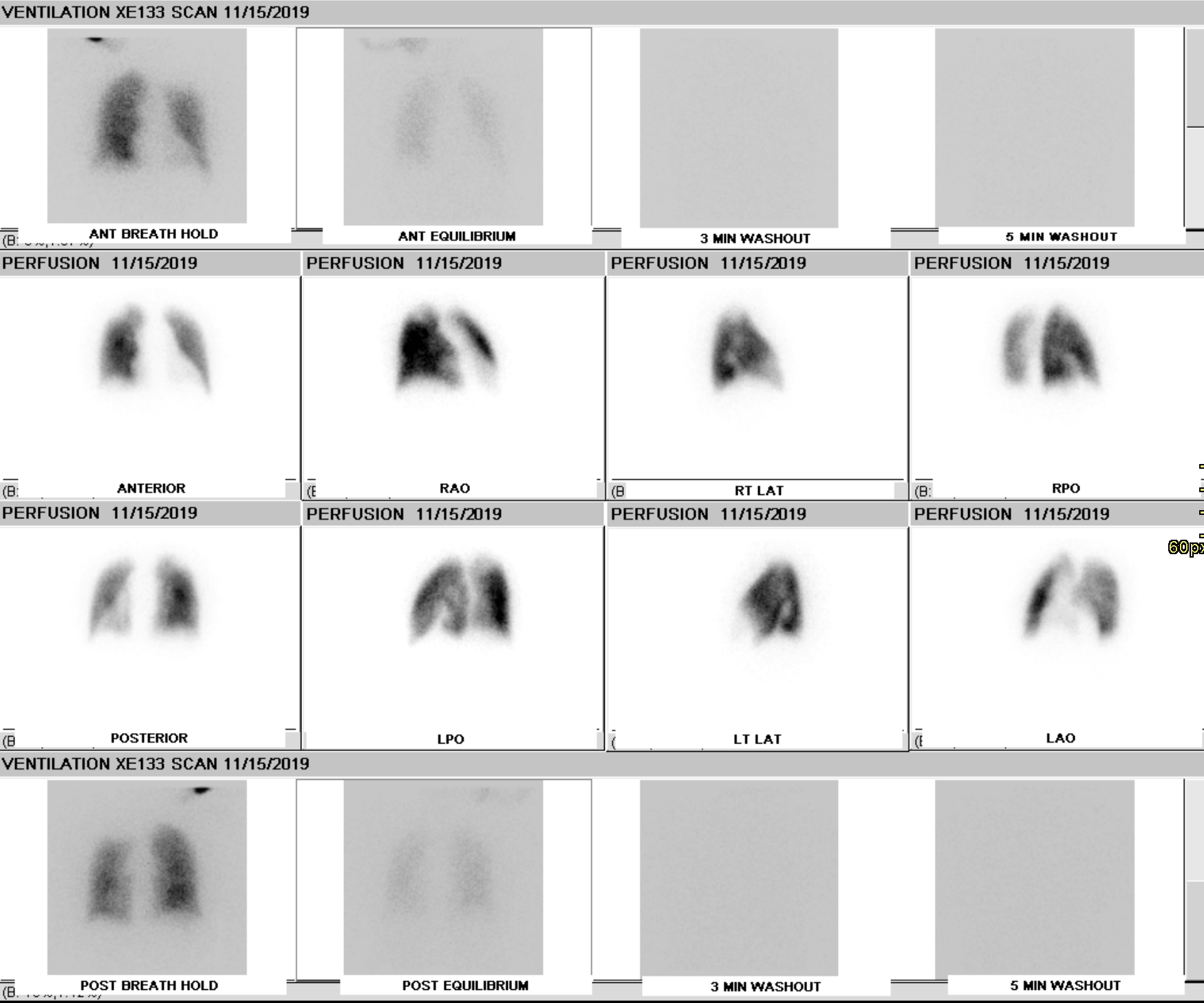 <p>CTEPH Ventilation-Perfusion Scan