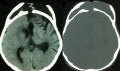 Leptomeningeal cyst