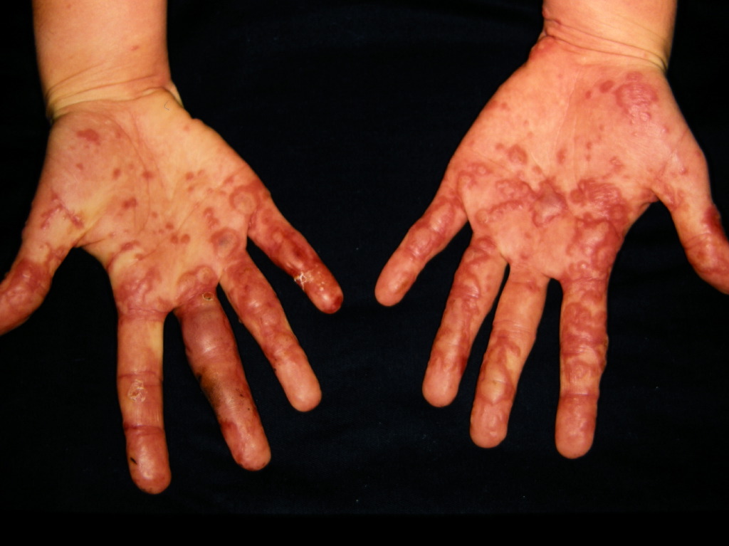 <p>Erythema Multiforme</p>