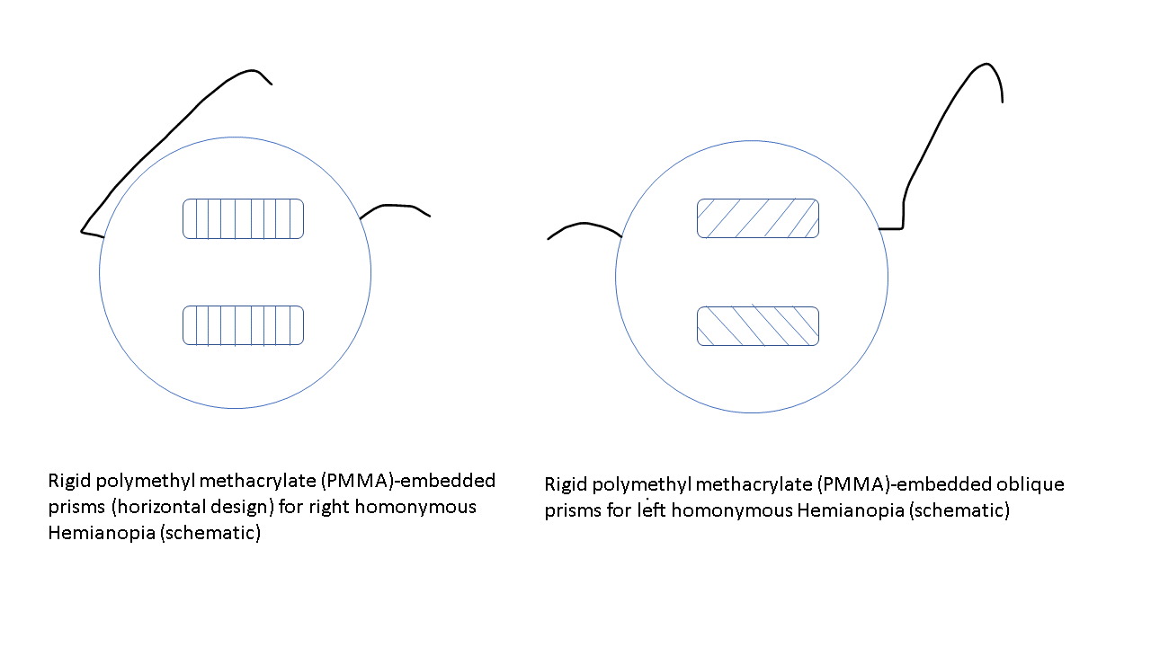 Rigid polymethyl methacrylate (PMMA)-embedded prisms