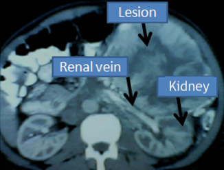 Giant pheochromocytoma