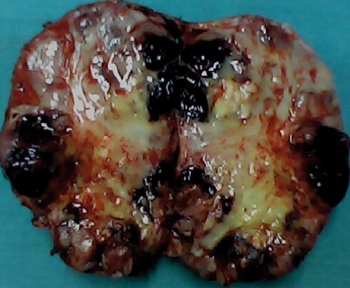 Gross specimen of giant pheochromocytoma