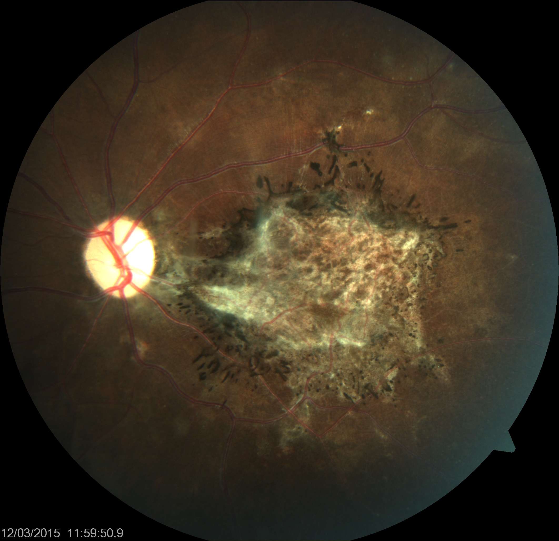 <p>Subacute Sclerosing Panencephalitis