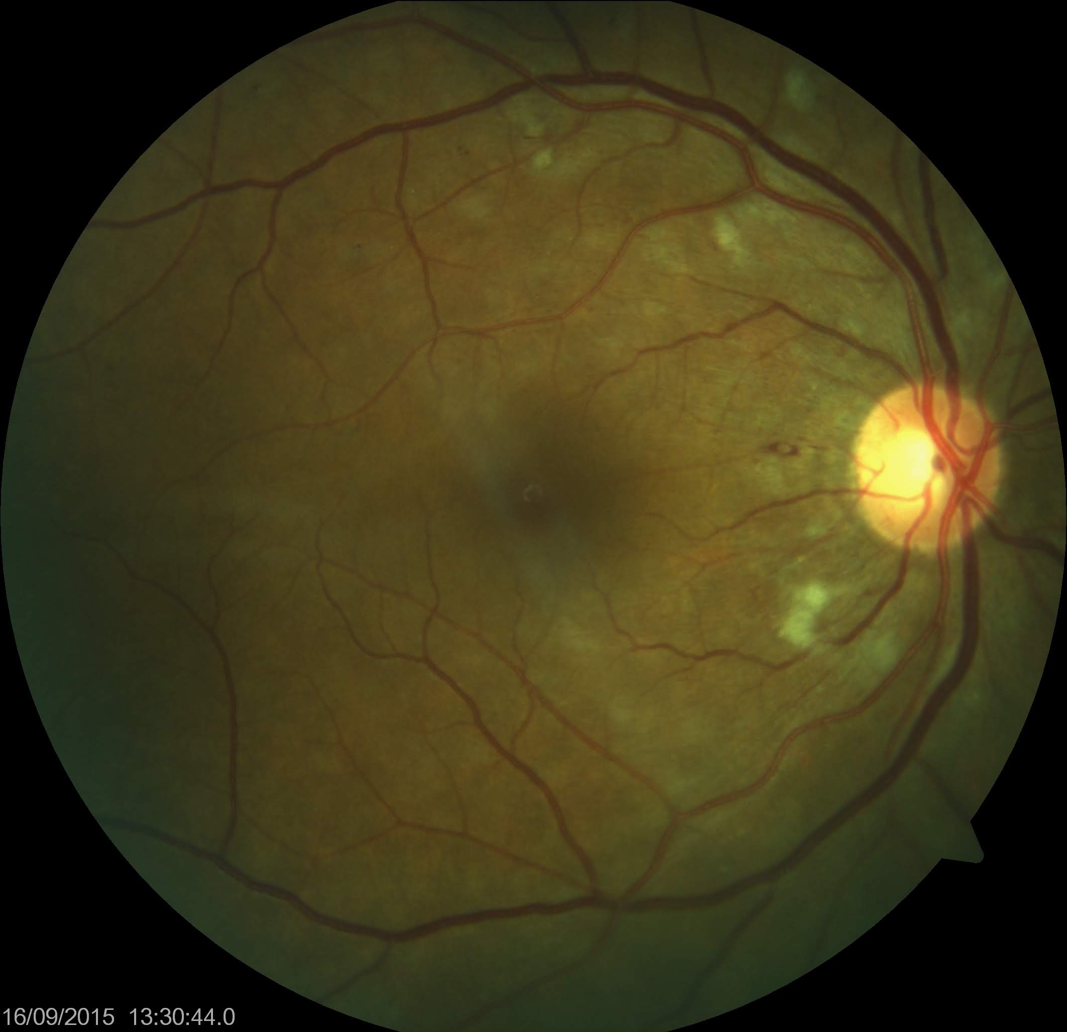 <p>Cotton Wool Spots. Cotton wool spots were observed in a patient taking interferon during a funduscopic examination.</p>