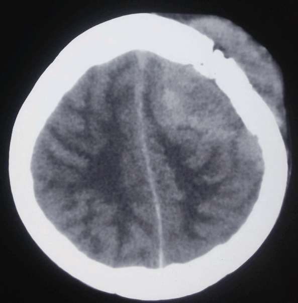 <p>Central Nervous System Lymphoma, Hyperdense Calvarial Based Lesion