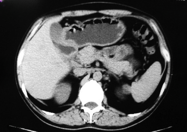 <p>Computed Tomography, Abdomen