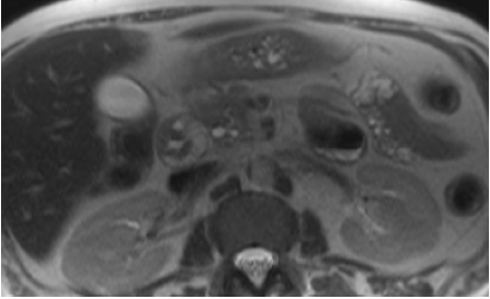 <p>Magnetic Resonance Imaging, Abdomen With Cystic Changes