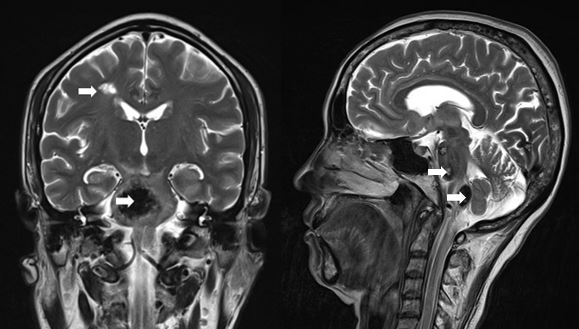 <p>Cavernoma Imaging Study. View of the characteristic "popcorn-like" appearance of a cavernoma seen on an MRI study.</p>