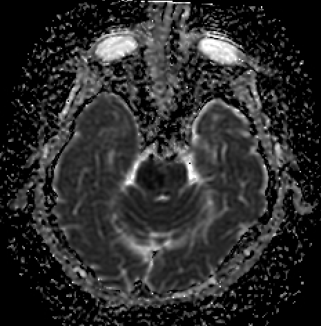 <p>Pontine Infarction. Imaging study showing features of a pontine infarction.</p>