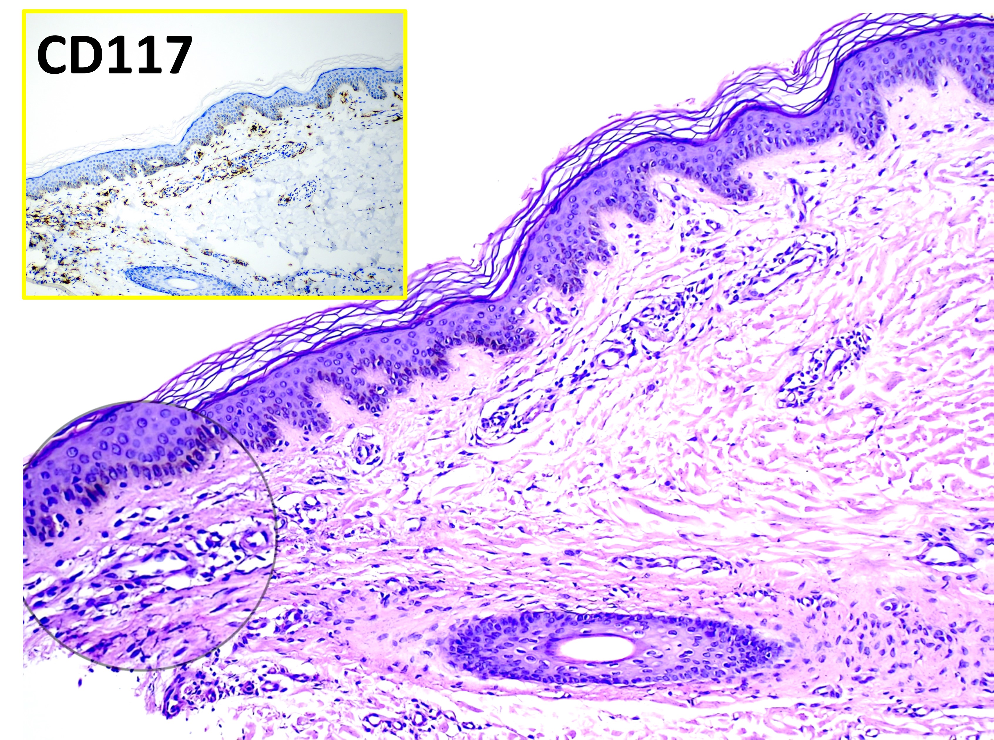 <p>Mastocytosis