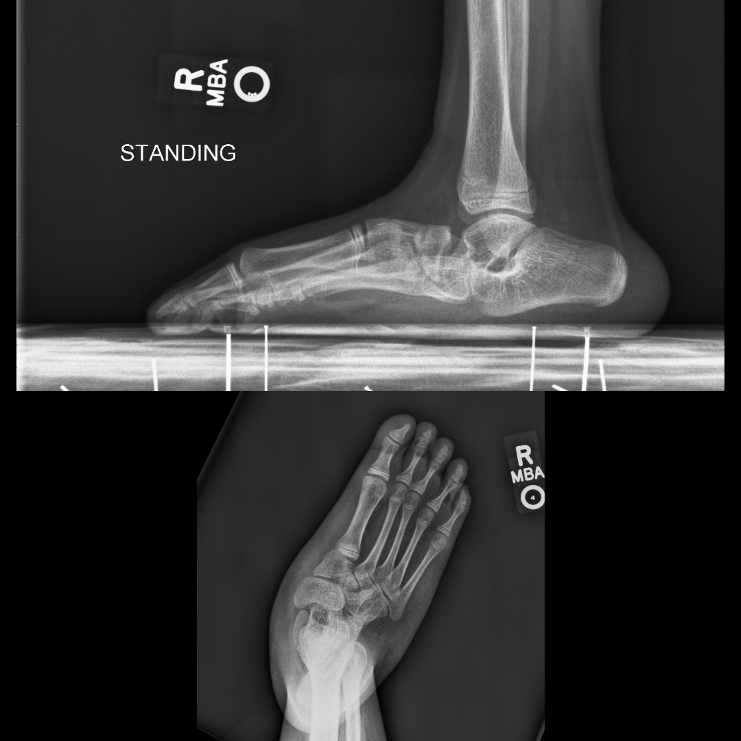 Congenital vertical talus