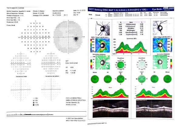 Normal visual field and Optical Coherence Tomography (OCT) results in a patients with ocular hypertension (OHT).