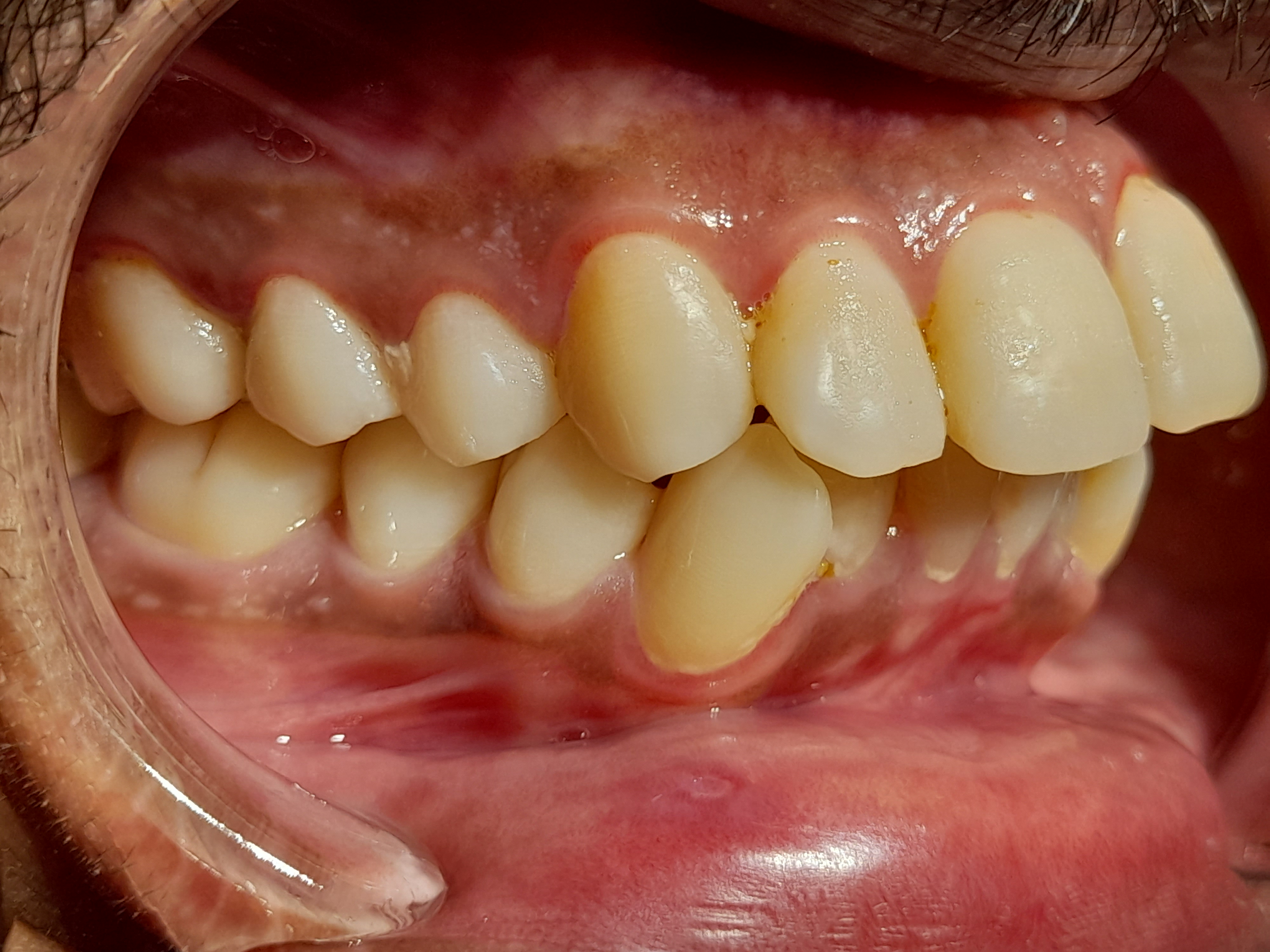 Angle class I molar relationship and Dewey type 2.