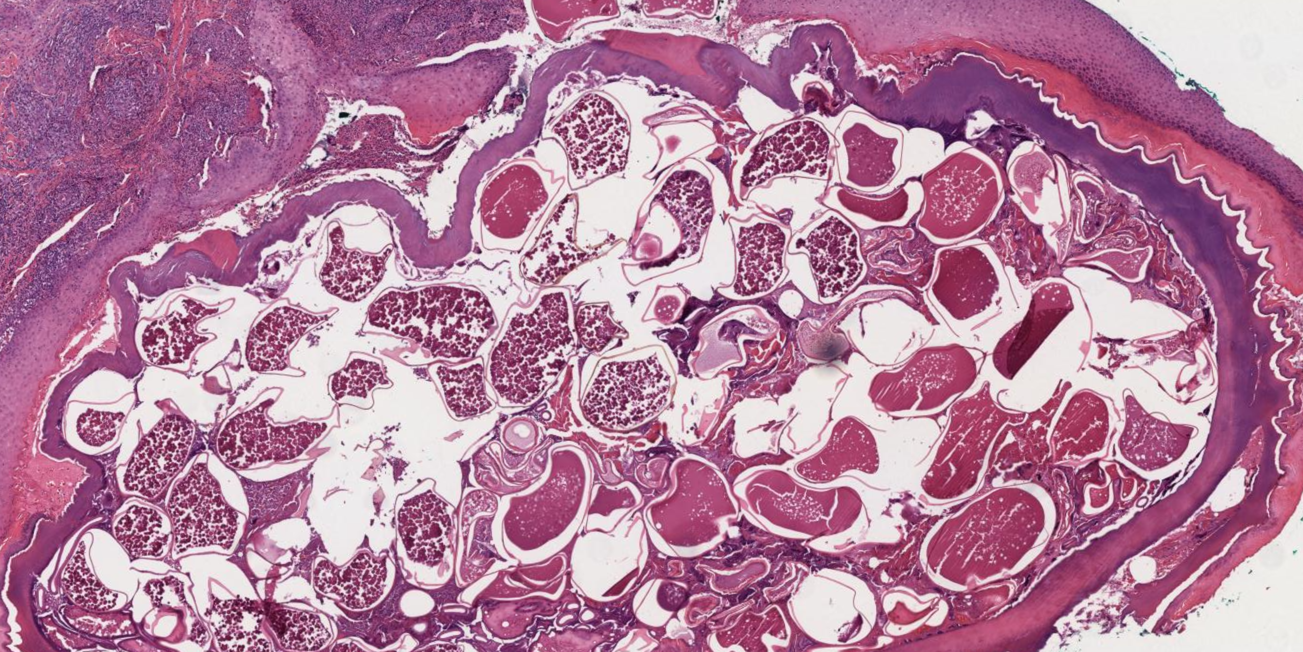 <p>Tungiasis Histology</p>