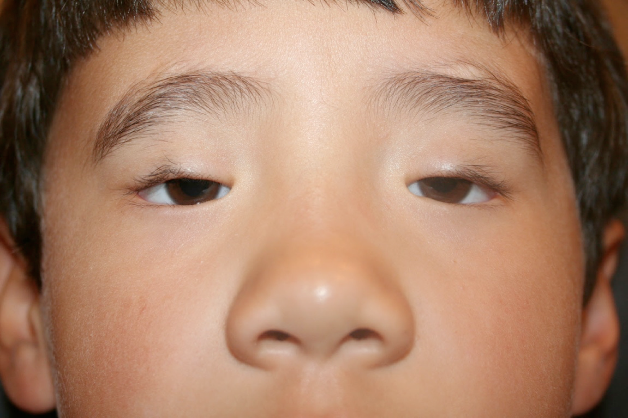 Male child with blepharophimosis syndrome