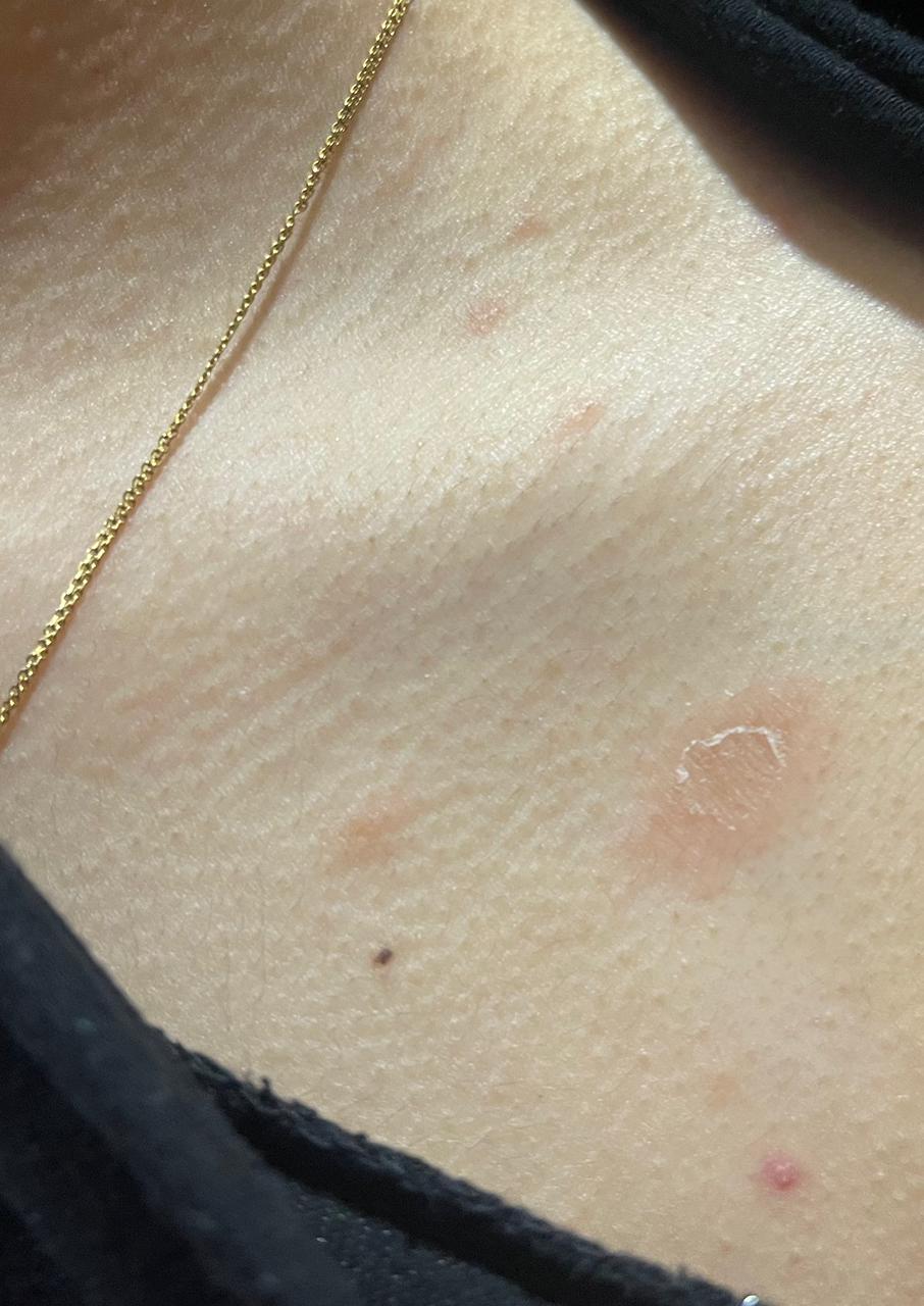 Collarette sign seen in pityriasis rosea