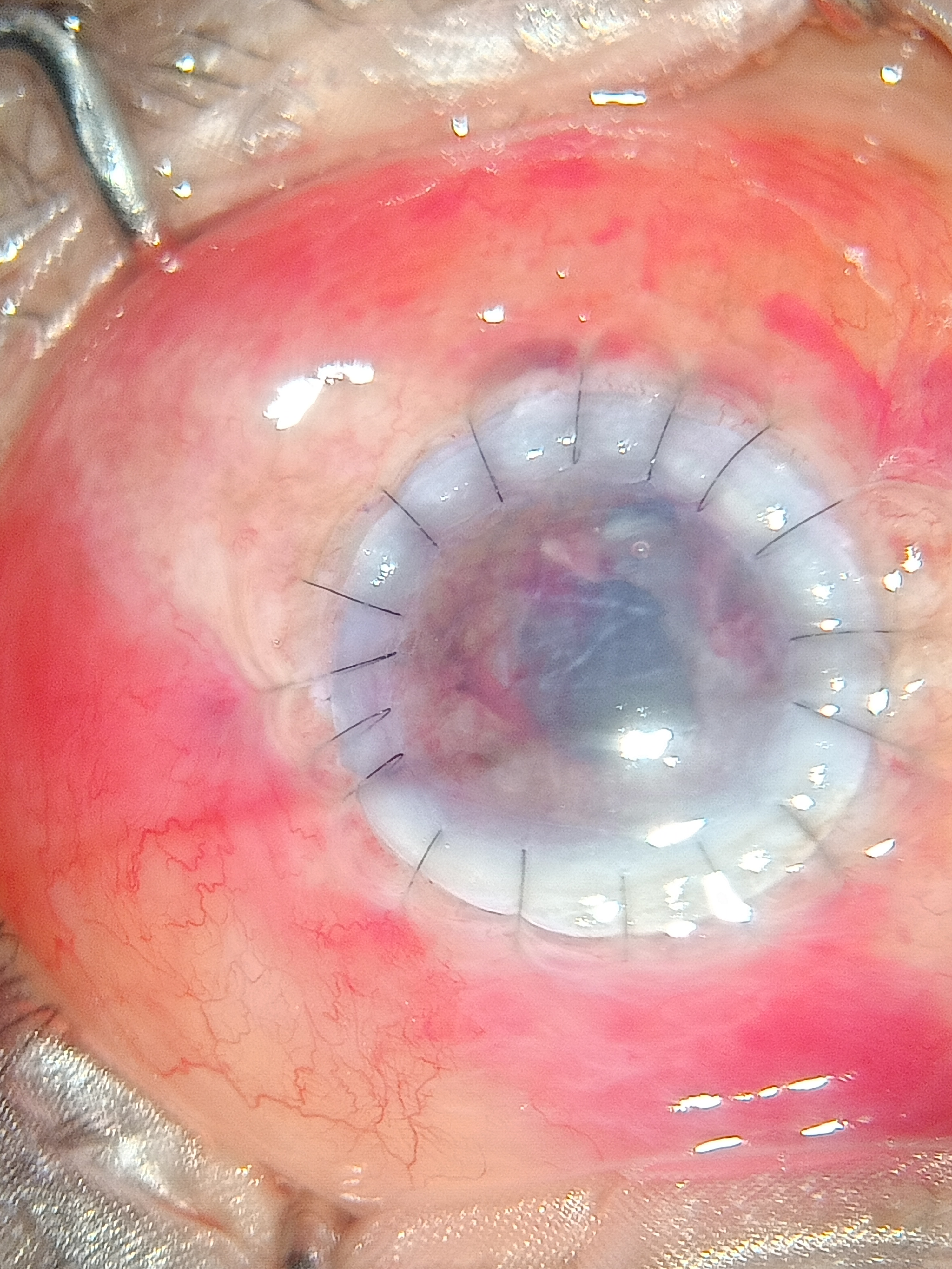 Digital image of the patient post tectonic keratoplasty depicting well opposed graft