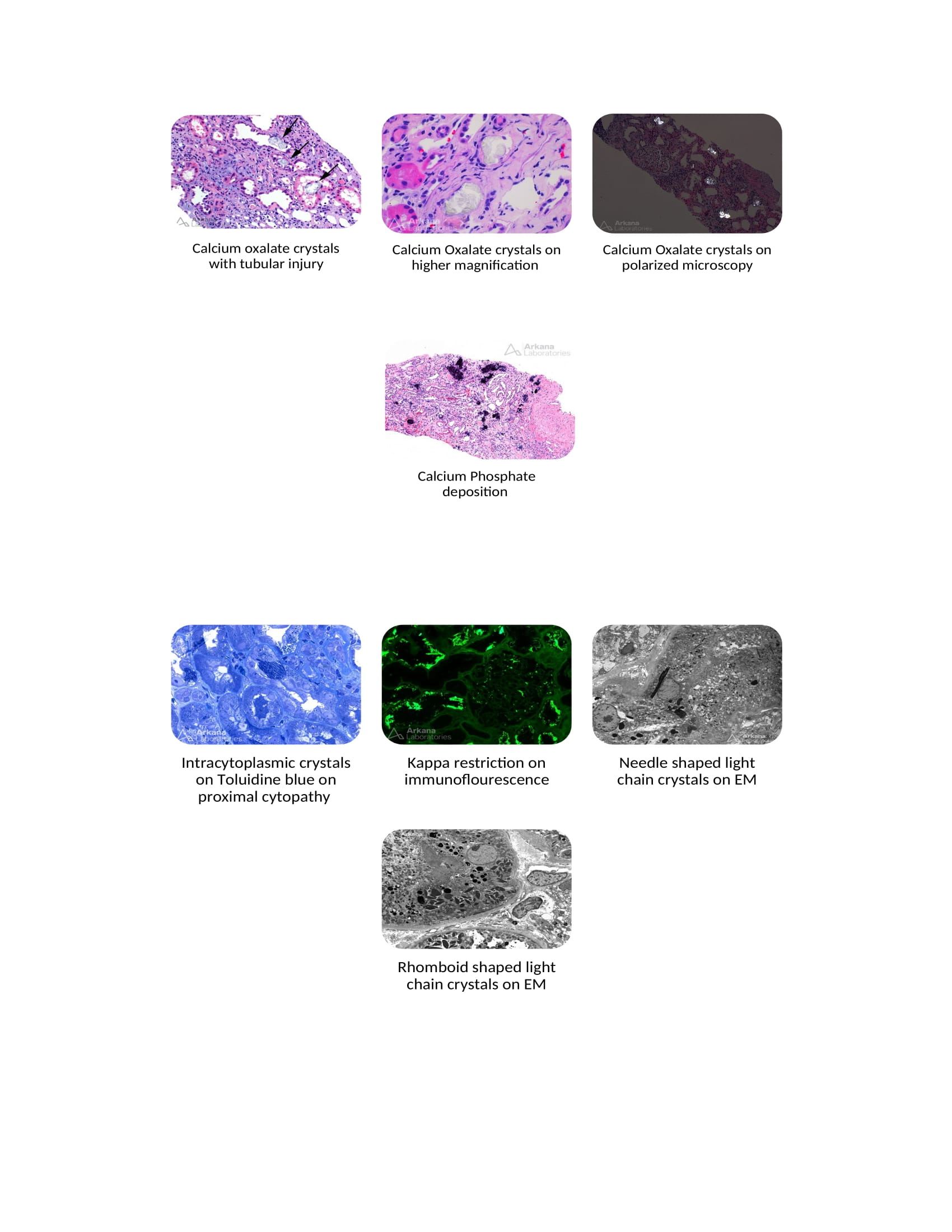 These pictures display the calcium oxalate crystals on renal biopsy specimens and light chain crystals on Proximal convoluted