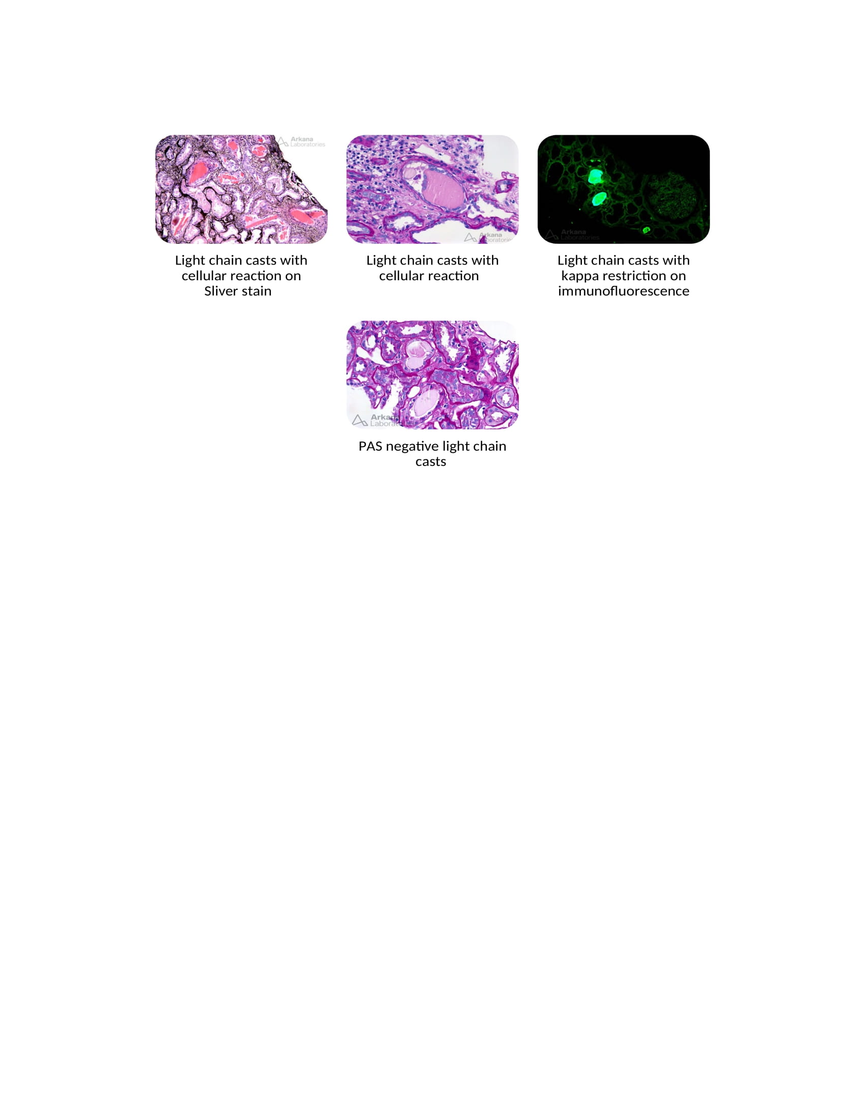 Light chain cast nephropathy slides