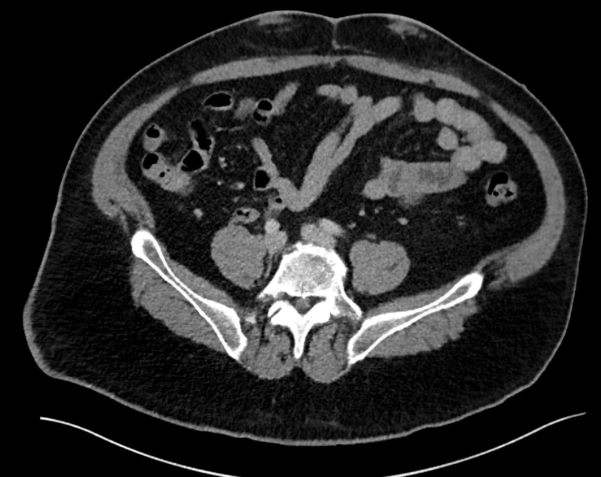 Patient 1: A 55-year-old male with type-2 insulin-dependent diabetes mellitus, chronic kidney disease, and suspected amyloidosis presents with painful, enlarging ventral abdominal masses corresponding to insulin injection sites