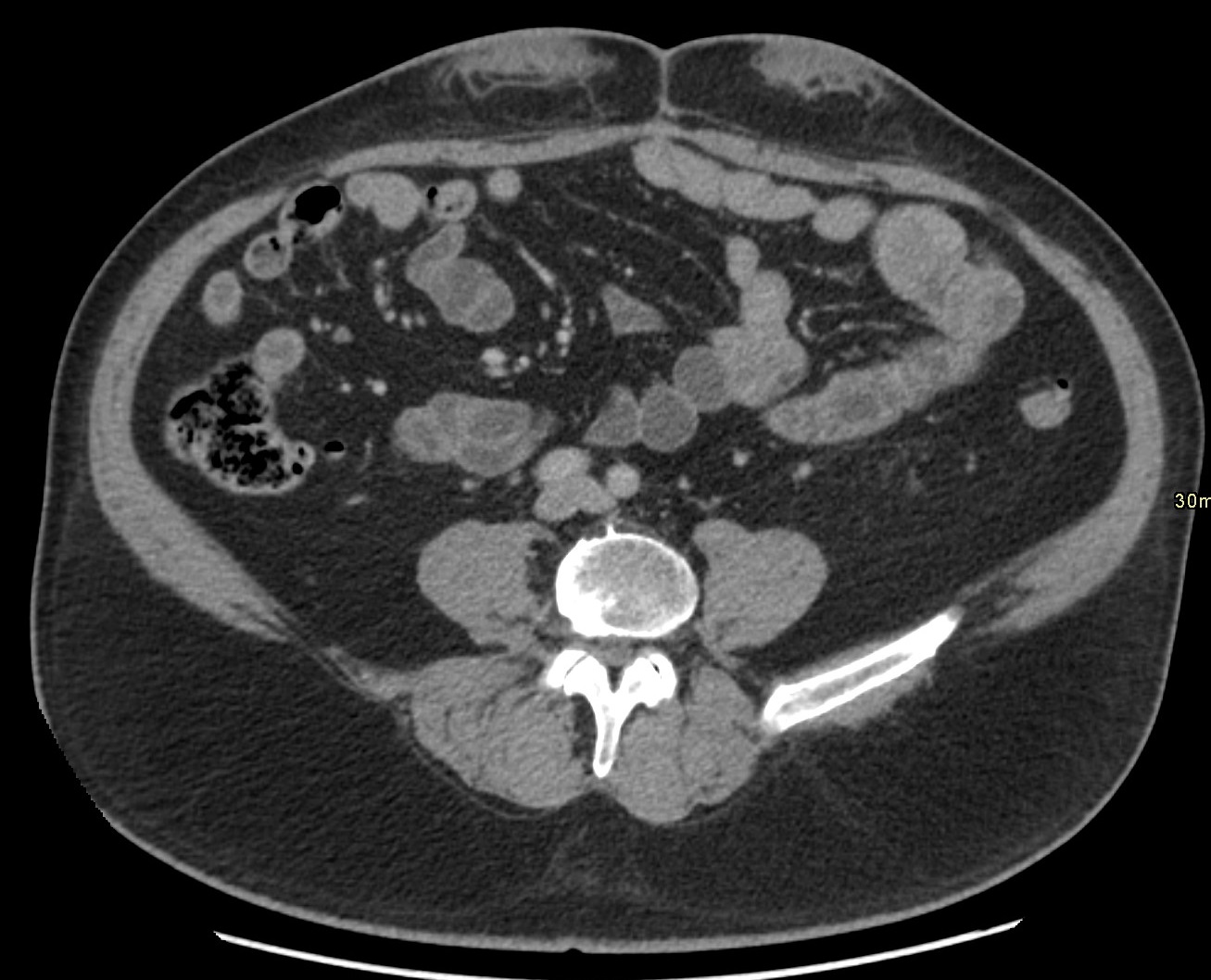 Patient 1: A 59-year-old male with type-2 insulin-dependent diabetes mellitus, chronic kidney disease, and suspected amyloidosis presents for a 4-year follow-up of painful, enlarging ventral abdominal masses corresponding to insulin injection sites