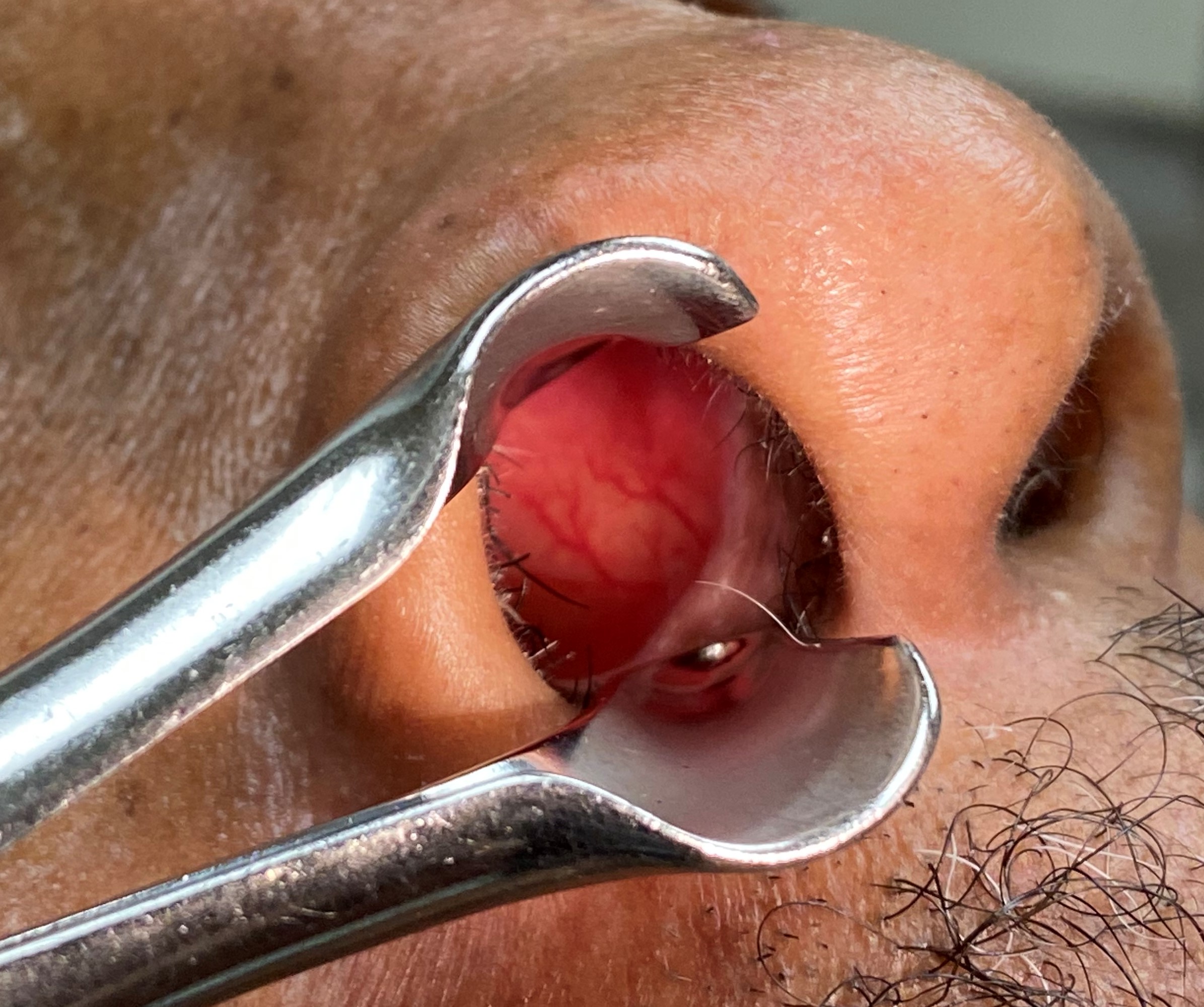 Vessels of Kiesselbach's plexus visible on the anterorinferior nasal septum, in Little's area