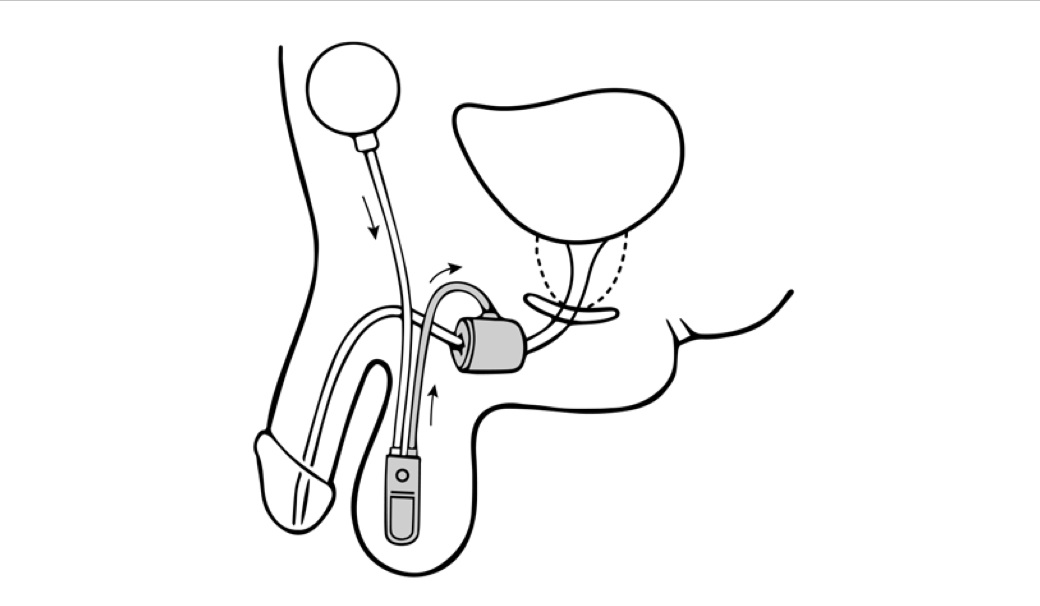 Automatic cuff inflation and urethral coaptation